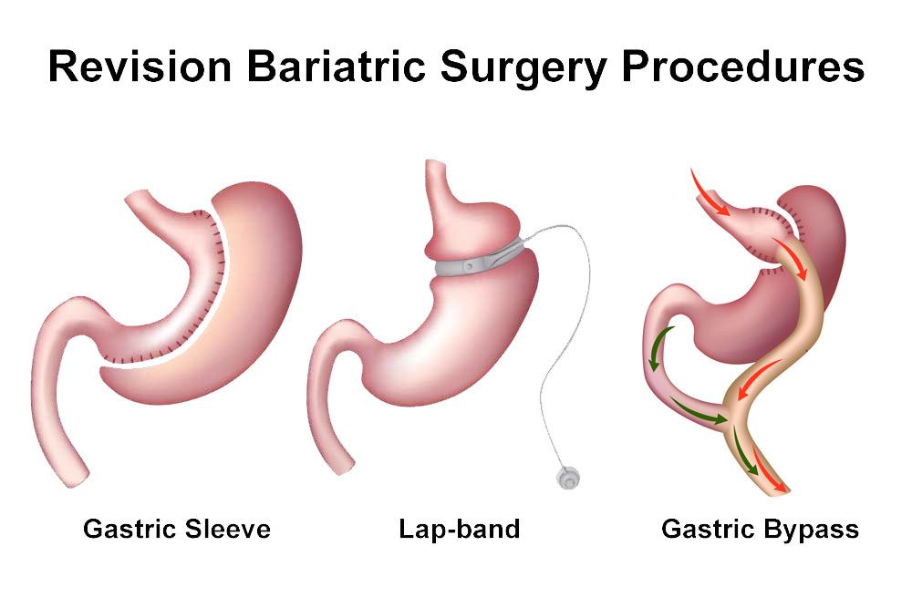 Illustration of revision bariatric surgery